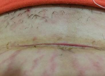 剖腹产拆线后48天伤口裂开,剖腹产后三个月伤口会裂开吗