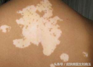 白癜风发病早期有什么手段能控制,对白癜风最有效的治疗