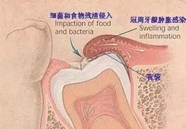 脸突然肿起来是牙的原因吗,智齿冠周炎一般肿几天