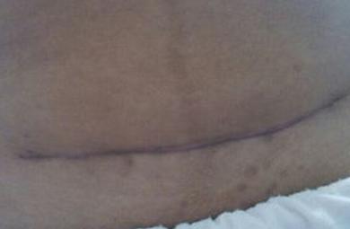 孕妇把剖腹产的伤口裂开了怎么办,孕妇剖腹产伤口裂开会怎样