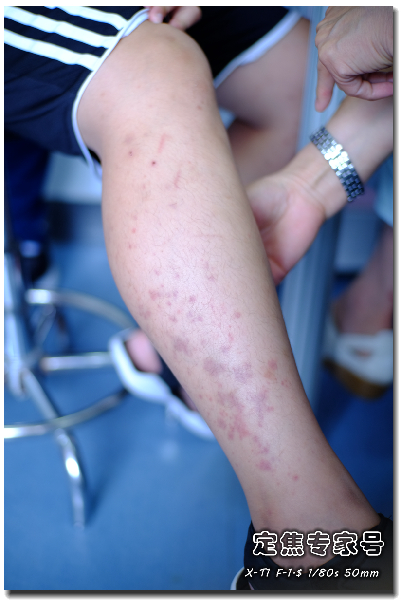 孩子肚子疼关节痛，等皮肤出了斑点才发现原来被它给骗了