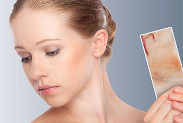 褐青色斑怎么预防,褐青色斑如何预防