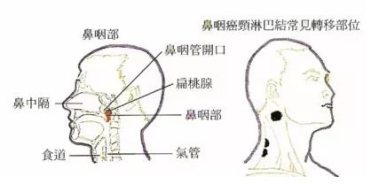鼻咽癌患者最新明细,早期鼻咽癌的患者治愈率和生存期