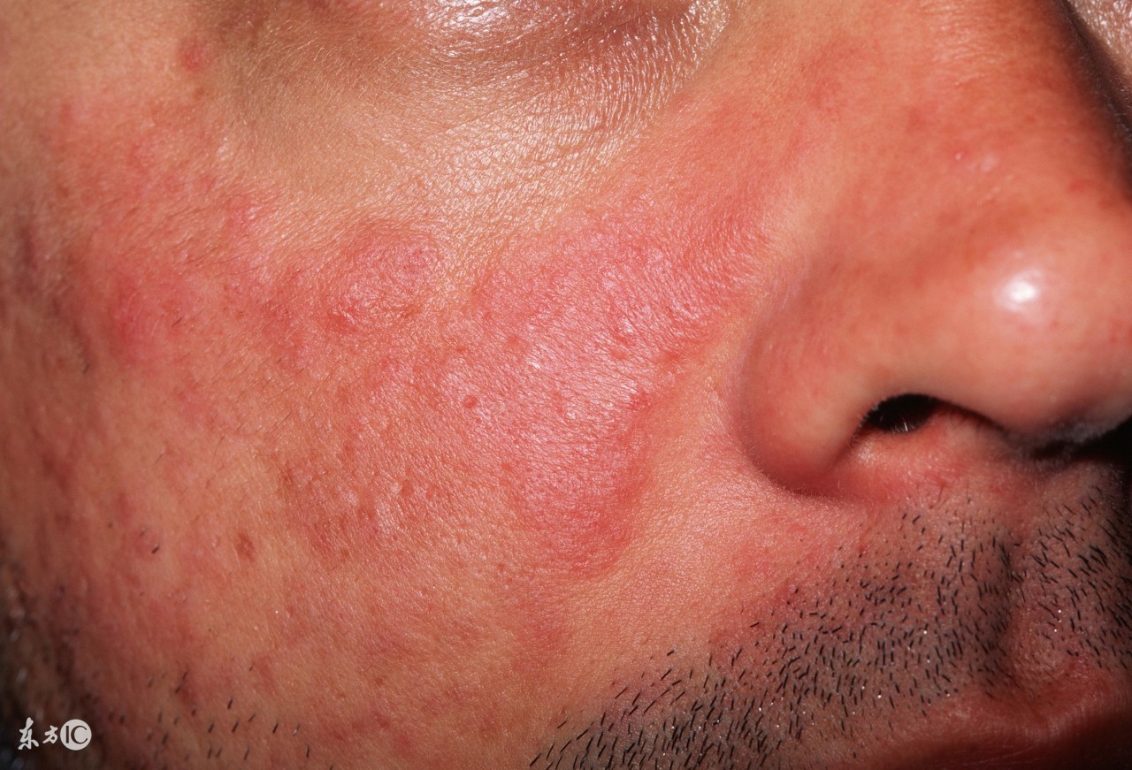 红斑狼疮早期怎么养生,红斑狼疮发现得早可以治好么