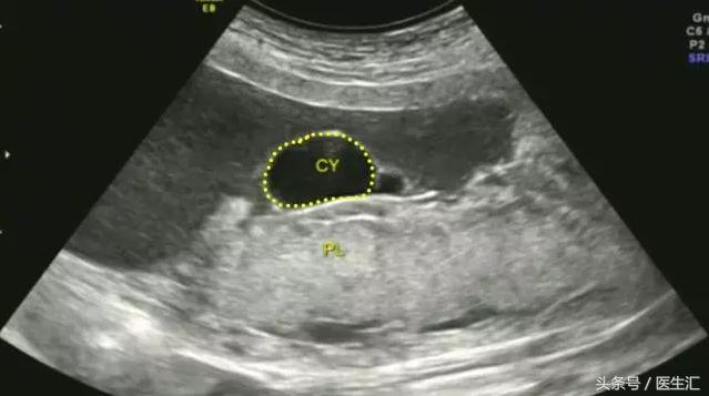 胎盘早剥是什么导致的,胎盘早剥是什么原因造成的胎儿肺炎