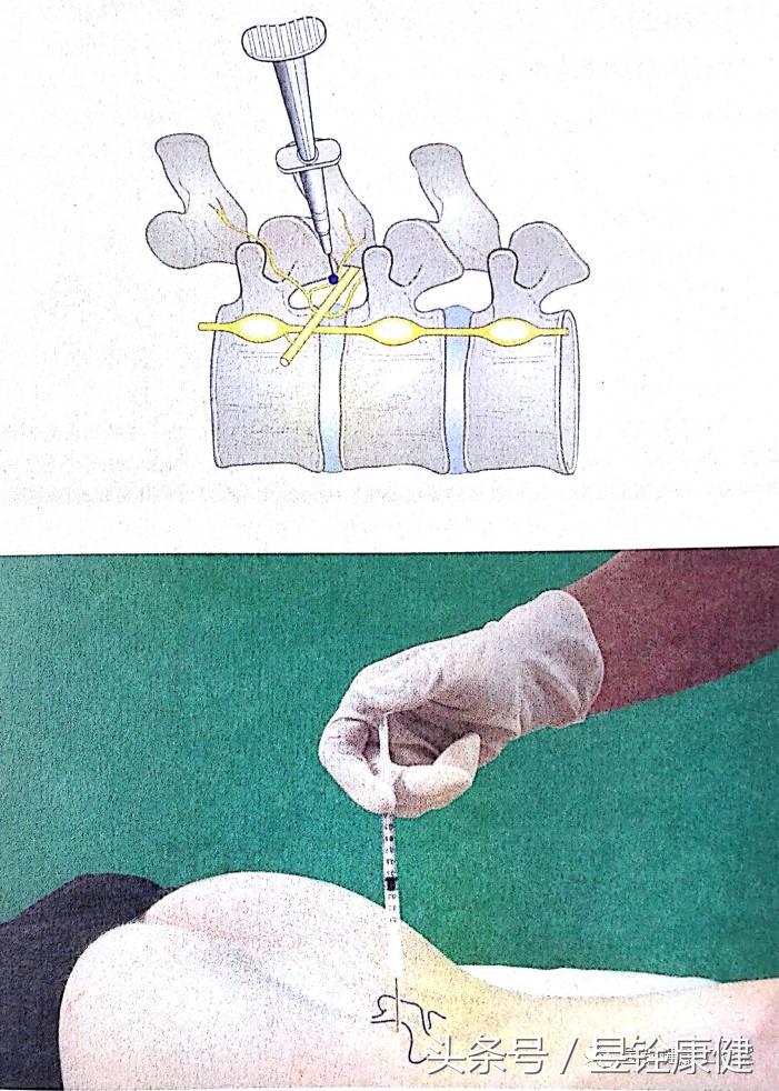 腰椎间盘突出症完全康复不是梦！早诊断、早治疗！