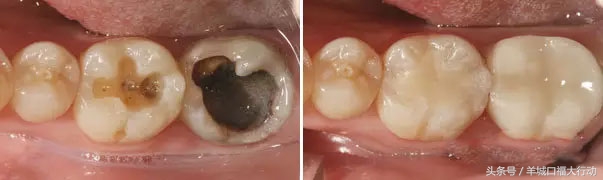 牙齿烂掉一半是拔掉还是根管治疗,牙齿烂掉一个