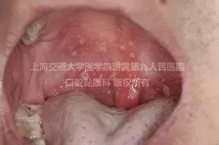 口腔溃疡太疼怎么上药,口腔溃疡很痛怎么办吃什么好得快