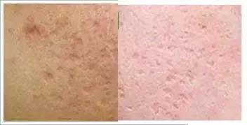 痘痘闭口一直不好,痘痘摸起来硬硬的很疼反反复复