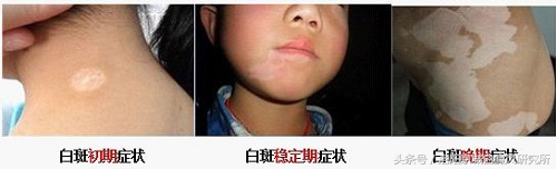 为什么都说面部白癜风好治,白癜风初期怎么治疗