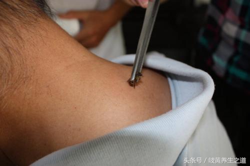 对蜂针免疫的人,蜂针治好后会死吗