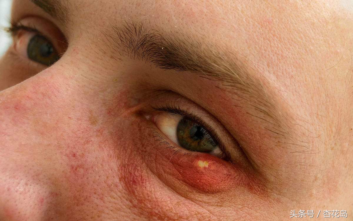 麦粒肿一般眼药水有用吗,中医眼科专家麦粒肿
