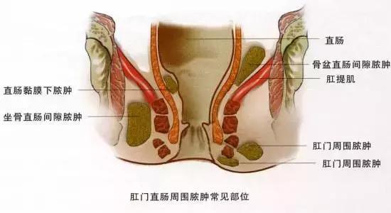 肛周脓肿的主诉,诱发肛周脓肿的原因都有哪些