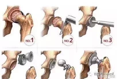 髋关节置换术后康复护理app,髋关节置换后护理康复训练视频