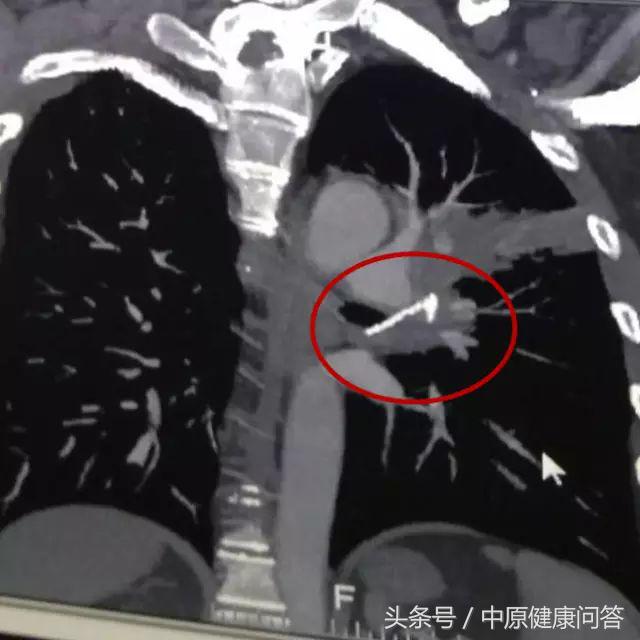 35男老咳嗽三个月,小伙咳嗽一年检查肺里有异物