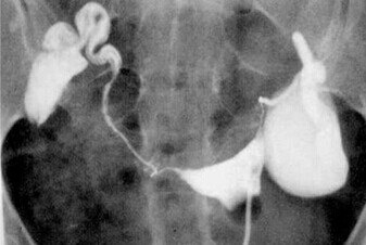 试管促排第九天时发现输卵管积水,试管婴儿输卵管造影