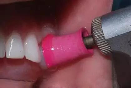 小孩牙齿表面一层黑能去掉吗,牙齿有块黑的怎么去掉