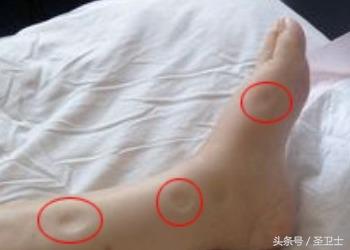 哪种水肿是肾病导致的？肾病水肿该怎么治？