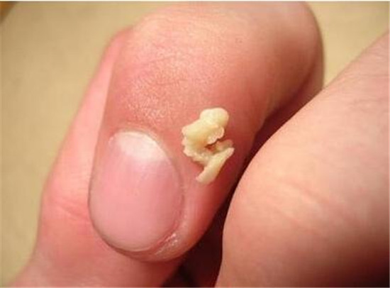 怎么可以彻底治愈扁桃体结石,扁桃体结石能否彻底治愈