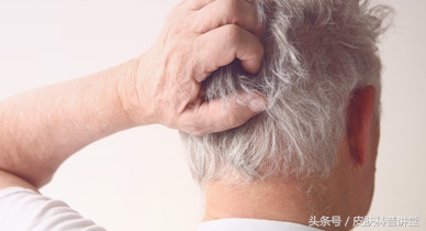 西医认为脂溢性皮炎的原因有什么,脂溢性皮炎发病年龄及发病率