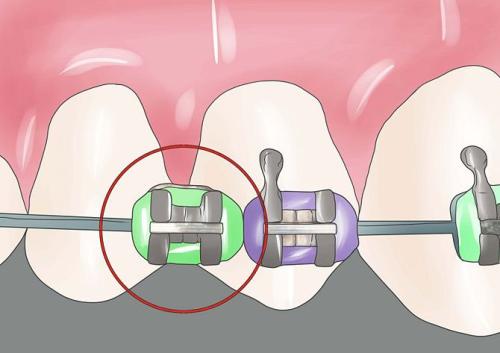少了一颗牙齿戴牙套矫正全过程,不用牙套能不能把龅牙搞回去