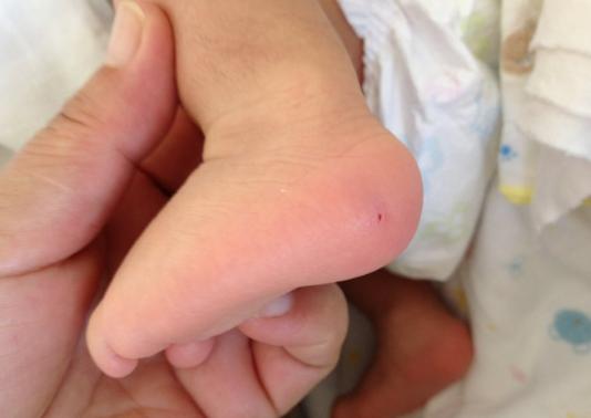 新生儿足跟血可以检查智力吗,新生儿足跟血哪一项影响生长发育