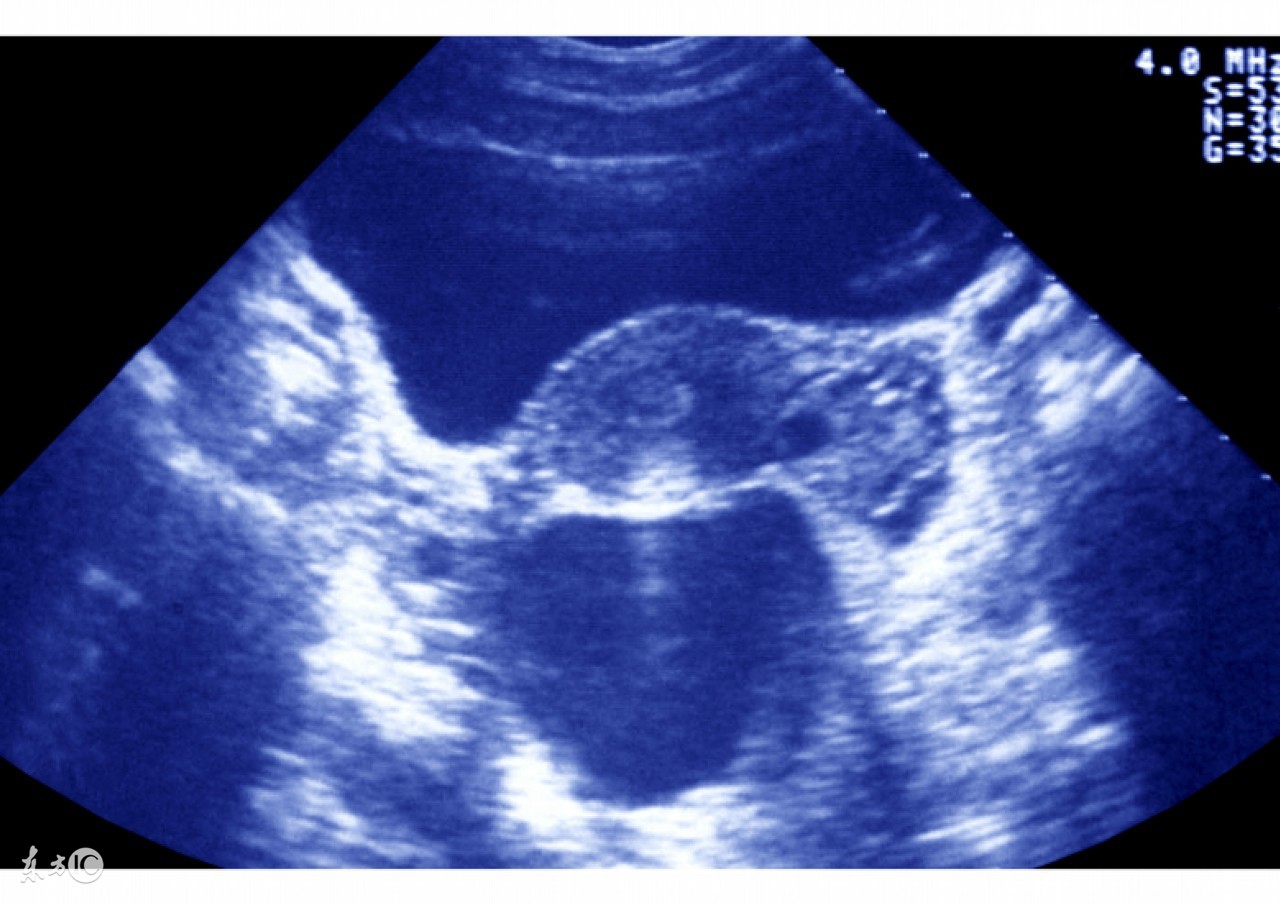 女性盆腔积液是什么引起的,女性盆腔积液是什么原因