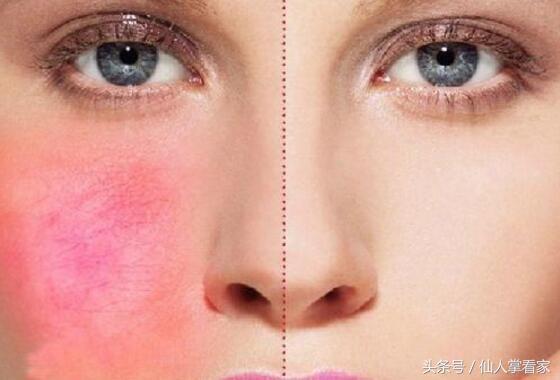 脸部过敏后如何修复,脸部过敏能不能吃氯雷他定片