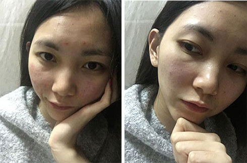 跟我这样做,不出3个月,痘痘全消散