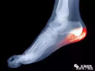 足底筋膜炎看啥科,足底筋膜炎去医院挂骨科还是外科