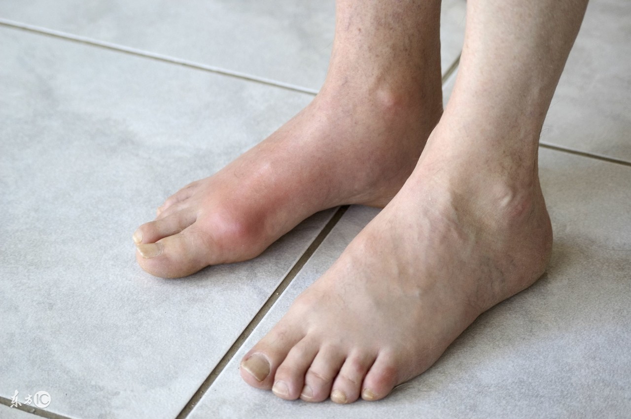 痛风应该如何治疗比较好