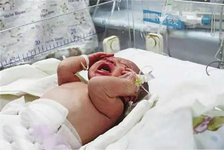 急产容易出现胎儿窘迫吗,宝宝出意外