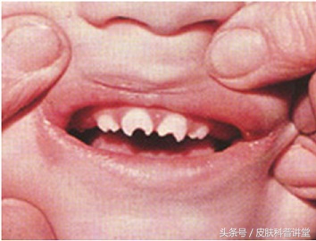 胎传梅毒诊断标准,胎传梅毒能彻底治愈吗