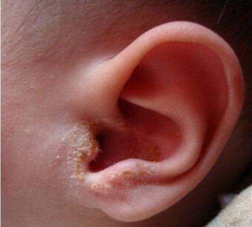 7个月宝宝中耳炎怎么处理,7个多月宝宝中耳炎症状