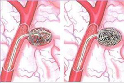 超声波治疗血栓,弱激光治疗心脑血管病