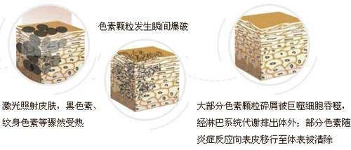 激光祛斑后怎么避免黑色素,激光祛斑后黑印子多久消失