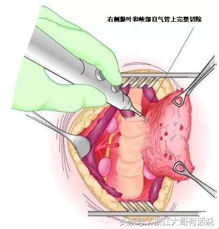 发现甲状腺结节如何处理,发现甲状腺结节怎么处理