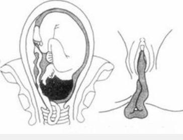 羊水多少才算正常,孕中期羊水多少才算少