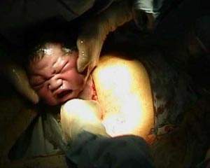 剖腹产修复盆底肌,剖腹产多久可以修复盆底肌