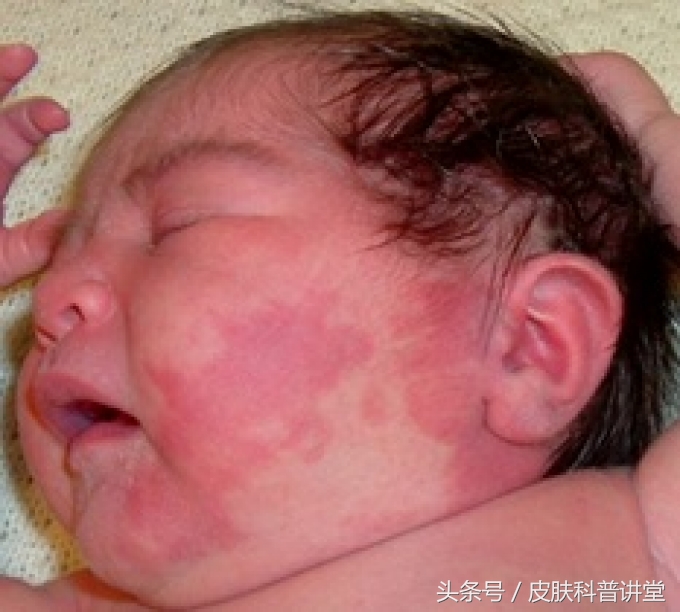 冷冻可以治疗鲜红斑痣胎记吗,治疗鲜红斑痣胎记的方法有哪些