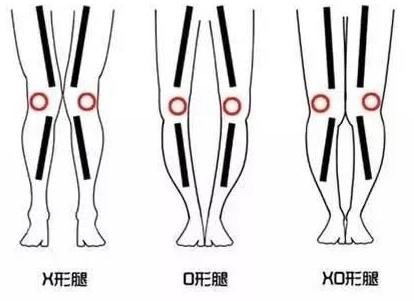 小腿不直什么动作矫正不外翻,矫正腿型小腿外翻的动作