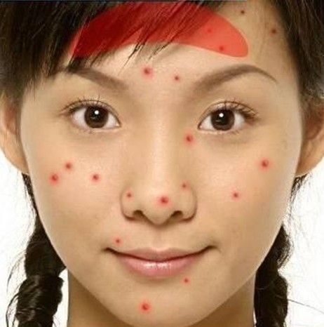 痘痘留下的坑印怎么办,脸上痘痘擦什么药膏不留印