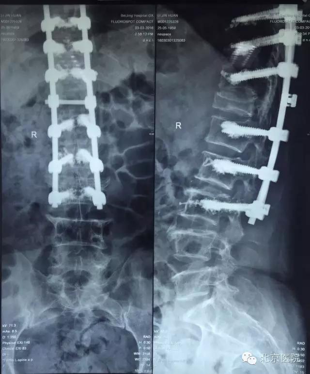 骨科医生教你改善驼背,北京哪家医院治疗脊椎弯曲驼背