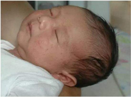 氨基酸奶粉能使过敏的小孩脱敏吗,奶粉过敏多久可以脱敏