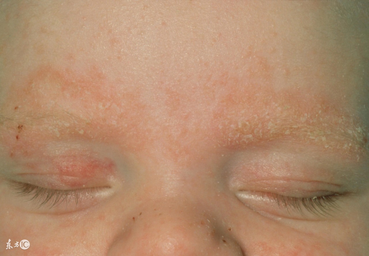 专业医学级别的激素脸（激素皮炎）四步疗法