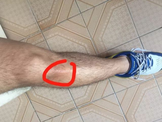 髌腱支持带在哪个位置,髌腱炎和髌腱末端病的区别