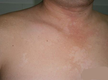 一个不能忽略的感染,皮肤真菌感染的药物治疗