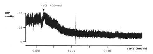 良性高颅压怎么治疗,高颅压治疗