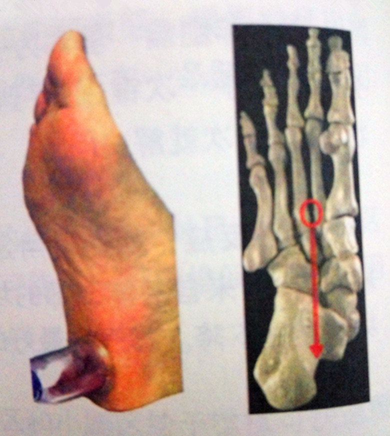 足部护理足跟痛,足跟痛足底穴位