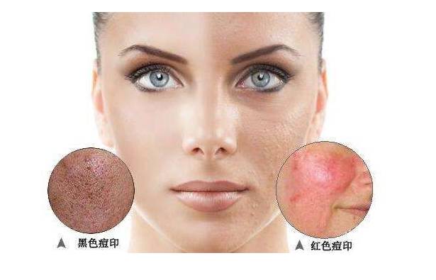 挤完痘痘后皮肤护理视频,挤完痘痘修复视频